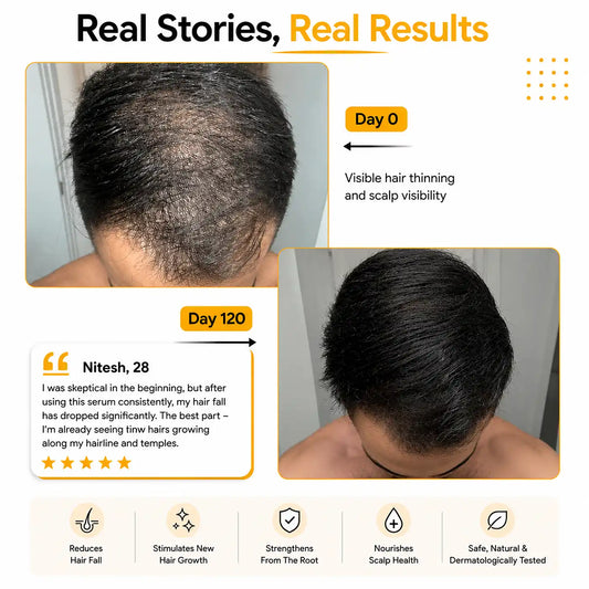 Real customers results Root Botanie Folliwise Men Hair Growth Serum faster hair growth designed for men only , best hair regrowth serum No Minoxidil.