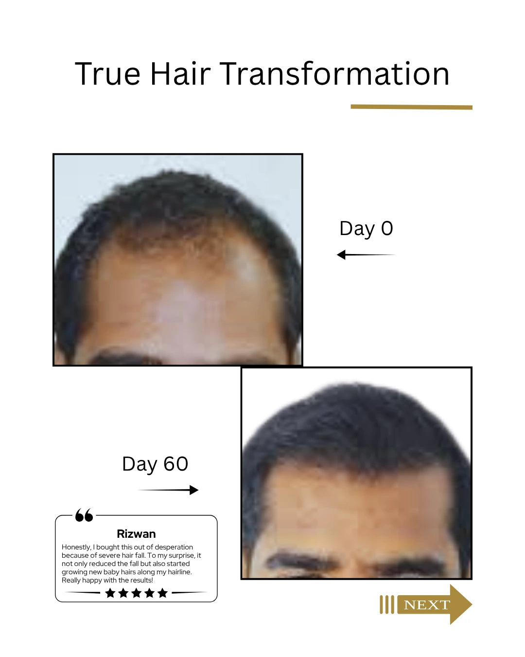 True Hair Transformation before and after images with text labels on a white background dermatologist recommended India's  best hair regrowth serum for Men , Root Botanie FOLLIWISE men Scalp Microbiome Balance Capsules | Doctor-Recommended Hair Regrowth & Hairfall Control Supplement
