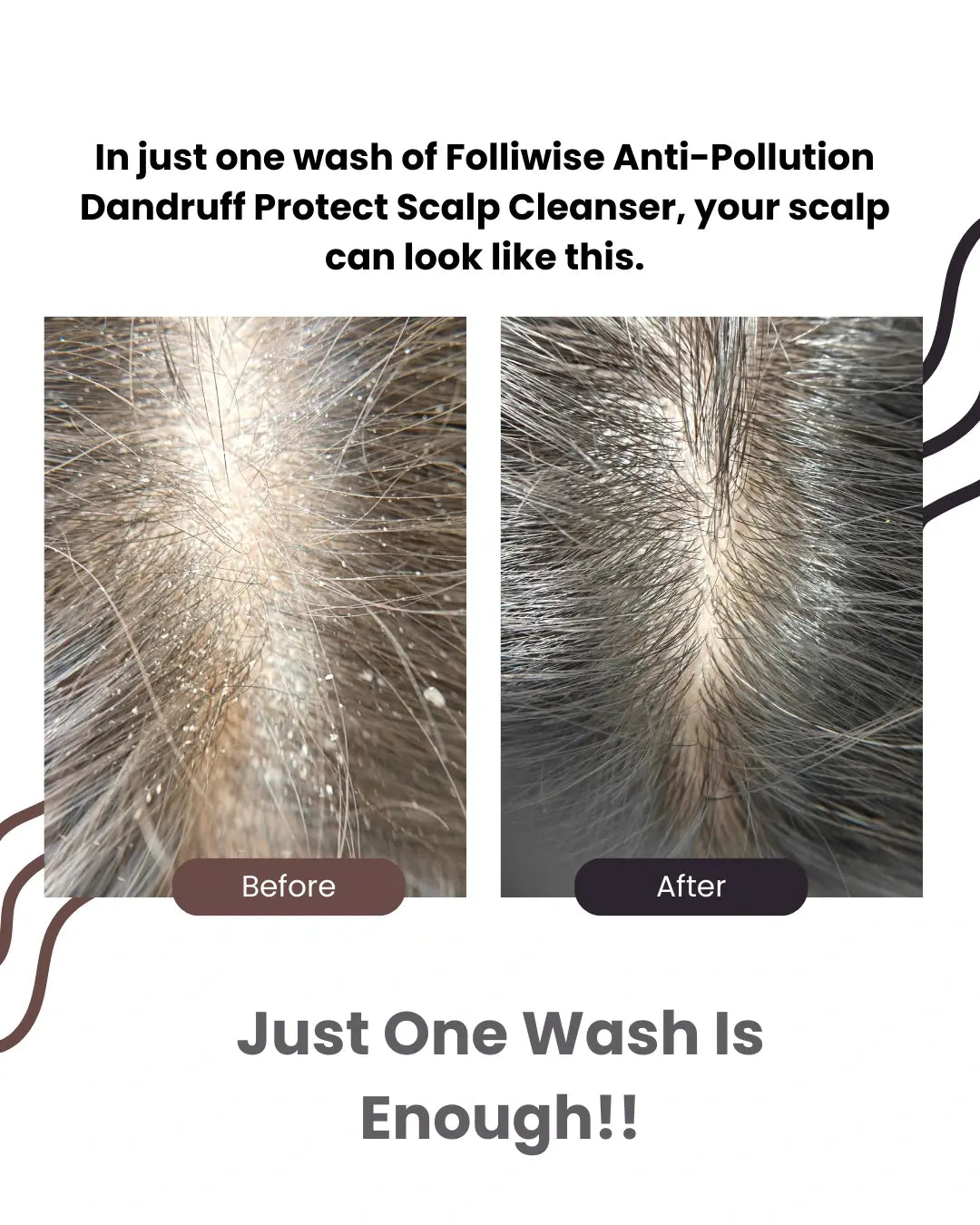 Before and after comparison of scalp with dandruff cleanser showing a cleaner scalp. Best Dermatologist recommended    Anti Dandruff anti hair fall shampoo Root Botanie Folliwise Anti Pollution Anti dandruff shampoo