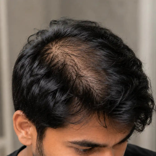 Reduce Thinning