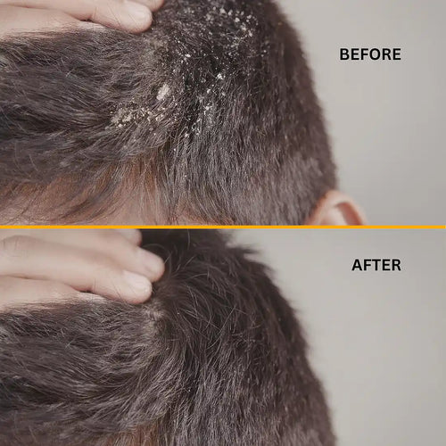 Control Dandruff