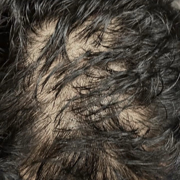 Extreme Hair Fall
